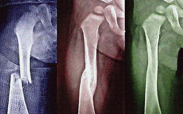 Nem minden törést mutat ki a röntgen